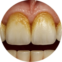 Пожелтения эмали зубов
