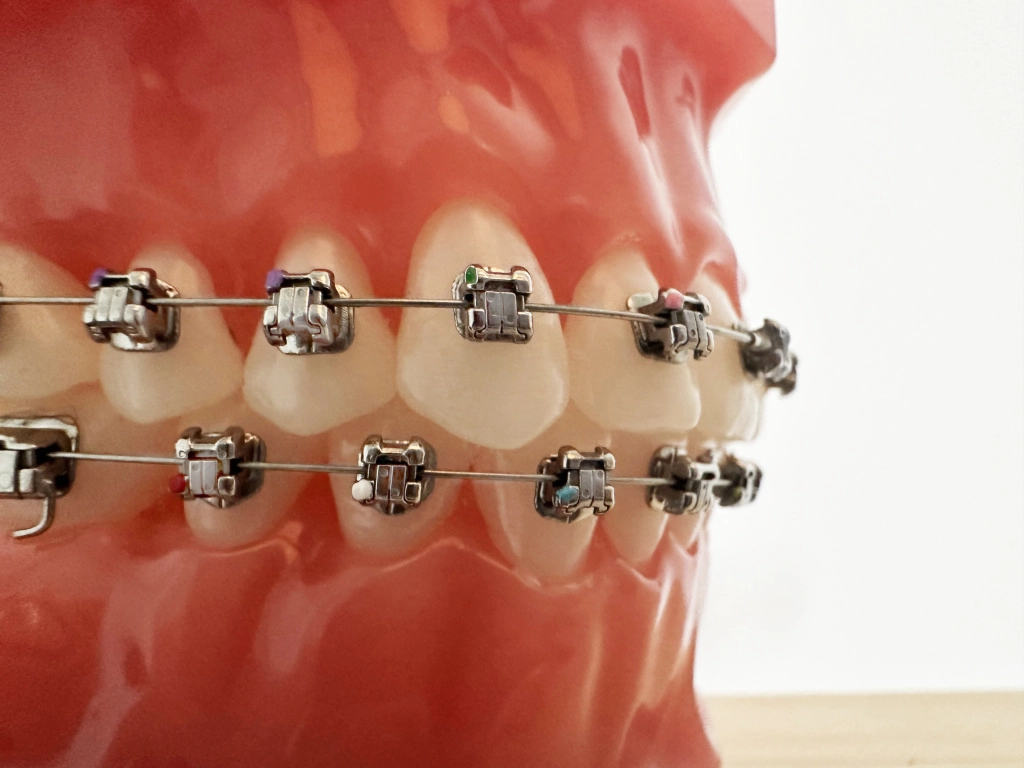 металлические брекеты1.jpg