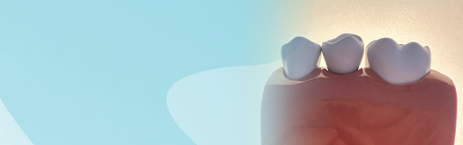 Зубной мост или имплант: что лучше выбрать?
