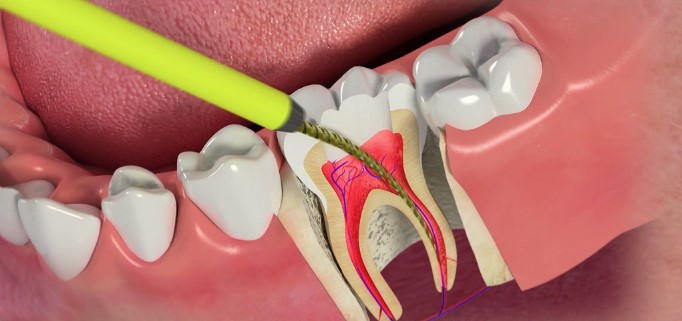 Удаление нерва зуба: причины и последствия