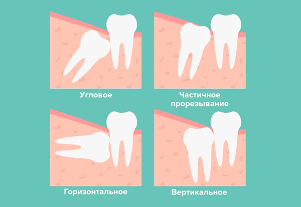 болит зуб.jpg