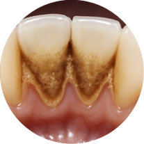 Образования зубного камня