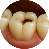 Возникновения кариеса