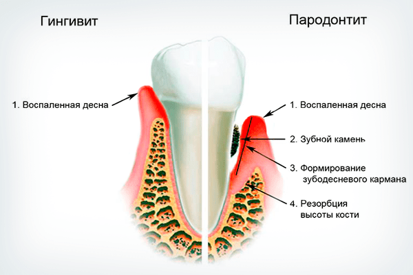 parodontit1-min.png