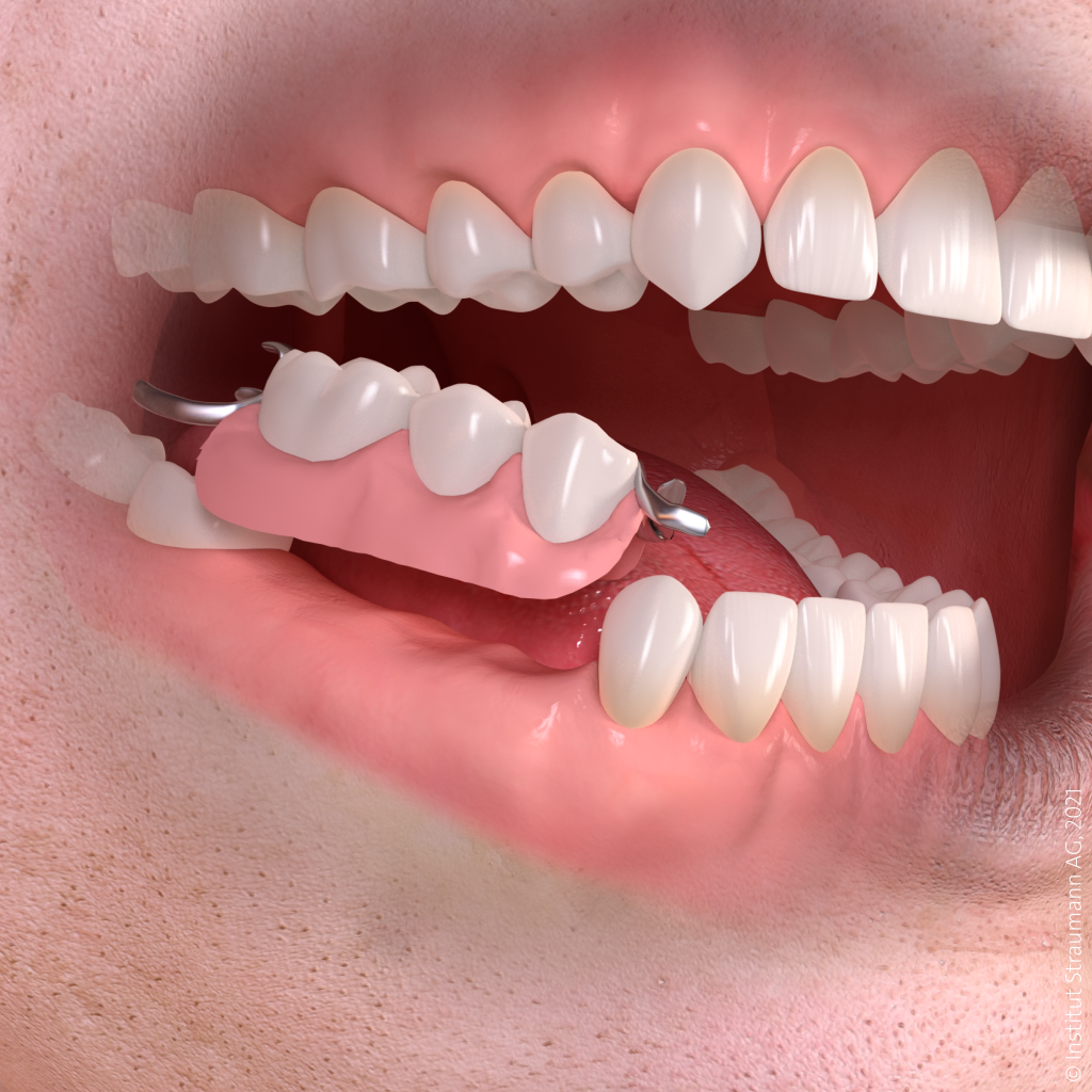 C_Traditional Partial Dentures_02 (2).png
