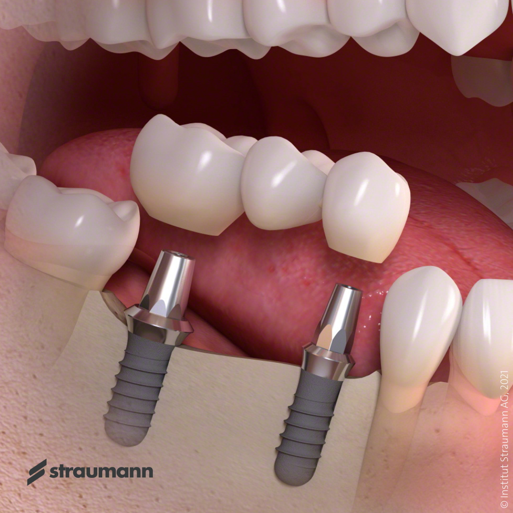 C_Implant-borne_multi-tooth_treatment_03 (2).png