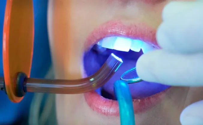 Пломбирование зубов: виды зубных пломб и для чего они нужны?